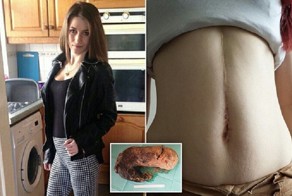 Хирурги удалили из желудка девушки 1,5-килограммовый ком волос