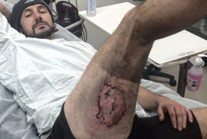 Велосипедист упал на свой iPhone 6 и получил сильный ожог