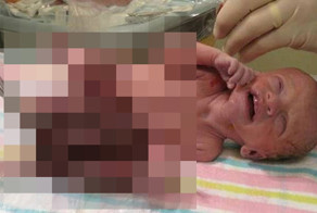 Ребенок с выпавшими органами