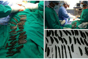 Индиец проглотил 40 ножей, потому что ему понравился их вкус