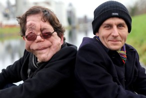 Болезнь сделала близнецов неузнаваемыми