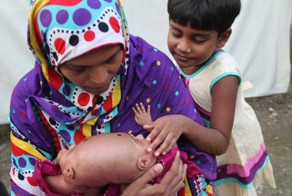 В Бангладеш родились редкие сиамские близнецы