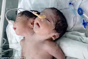 Ребенок в Индии, родившийся с двумя головами, прожил всего 32 часа после родов