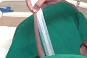 Индийские хирурги удалили парню 18-сантиметровый хвост