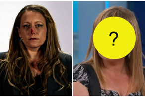 Ее парень откусил ей нос.Смотрите, как постарались доктора!