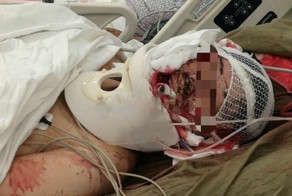 Последствия нападения тигра на женщину