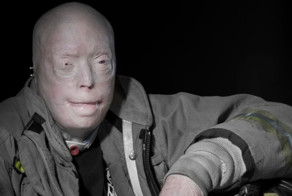 Патрик Хардисон: человек без лица получил новую личность