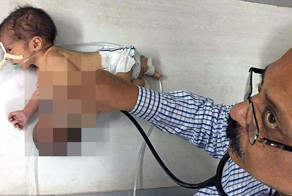 В Индии мальчик родился с головой и руками, своего брата на груди