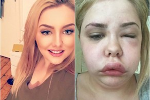 При переживаниях лицо и шея девушки увеличиваются вдвое