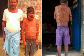 Тело 16-летнего юноши покрытое пузырями