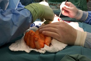 Хирурги пересадили руку пациенту, родившемуся без конечности