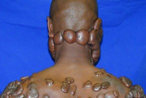 От келоидных рубцов избавиться не так просто