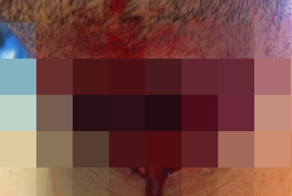 Рассечение горла в аварии на мотоцикле