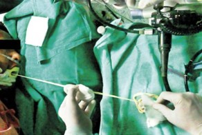 Индийские врачи извлекли двухметрового червя из кишечника мужчины