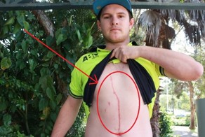Вы удивитесь, когда узнаете, что оставило этот жуткий след на теле парня