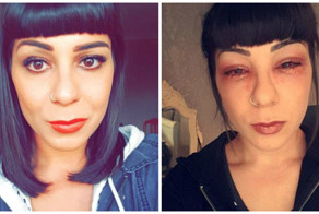 Девушка практически осталась без ресниц после процедуры наращивания