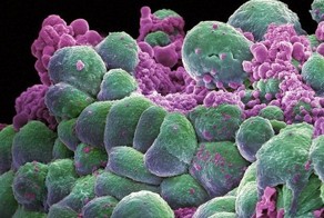 Как заболевают раком и что делать, чтобы избежать этого заболевания?