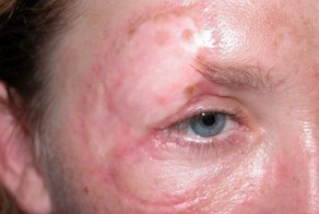 Женщину за лицо укусила собака