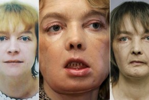 Пересадка лица: чудо руками хирургов