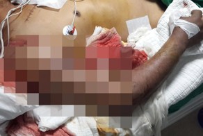 Восстановление руки при травматической ампутации