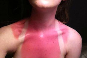 Перестарались с загаром, даже смотреть больно