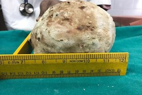 Хирурги извлекли из мочевого пузыря пациента огромный камень