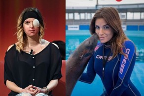 Итальянская модель впервые открыла лицо после того, как бывший облил ее кислотой