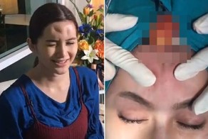 Врачи выдавили косметический наполнитель из лба женщины