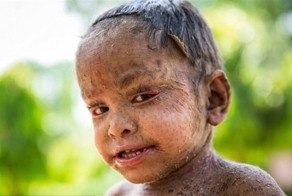 Кожное заболевание превратило маленькую девочку в "ящерицу"