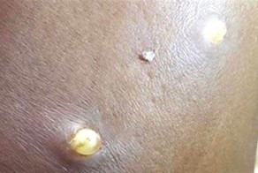 Личинки мухи под кожей на руке женщины