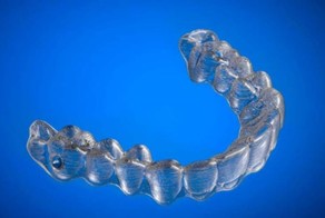 Парень создал с помощью 3D-принтера пластиковые брекеты, чтобы выровнять свои собственные зубы