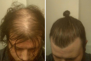 Мужчины, прячущие свои лысины под прической в виде гульки, даже не подозревают о последствиях