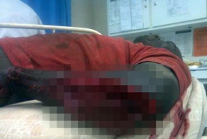 Африканец неслабо разодрал руку в ДТП