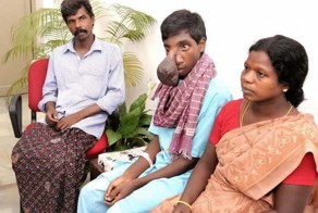 Индийскому подростку удалили с лица огромное образование