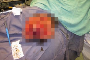 Мужчина средних лет лишился двух ног в аварии