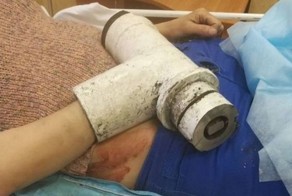 В детском лагере в Петербурге руку женщины затянуло в мясорубку