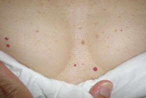 Что за красные точки на теле и чем они опасны?