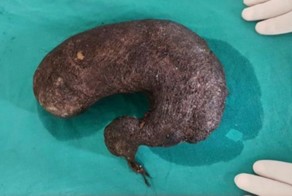 Огромный комок волос в желудке молодой девушки