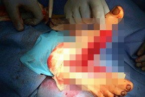 Самоубийца выжил но травмировал ногу