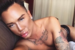 У канадца, увлеченного пластикой, не закрывается рот из-за инъекций филлеров