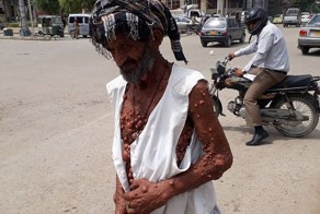 "Человек-пузырь" вынужден жить как затворник