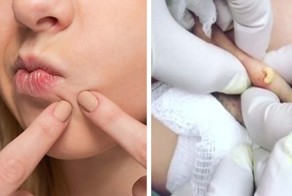 Как избавиться от прыщей: показывает дерматолог-звезда YouTube