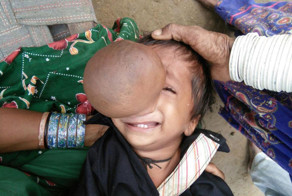 Пакистанский мальчик с  огромной опухолью на носу