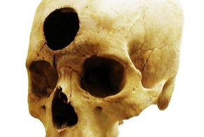 Трепанация - чудо древней медицины