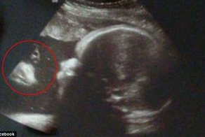 Пара "видит Иисуса" на УЗИ-снимке своего ребенка
