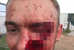 Последствия удара бутылкой по лицу