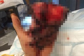 Хирурги спасли парню руку, зашив её в живот