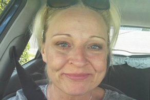 Женщина потеряла половину своего лица из-за бактерий