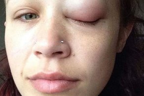 Канадская модель начала слепнуть, сделав татуировку на глазу