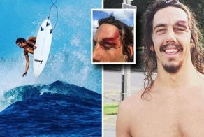 Рассечение головы спасло жизнь австралийского серфера